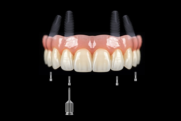 Why Choose Implant Supported Dentures? Top Benefits Explained