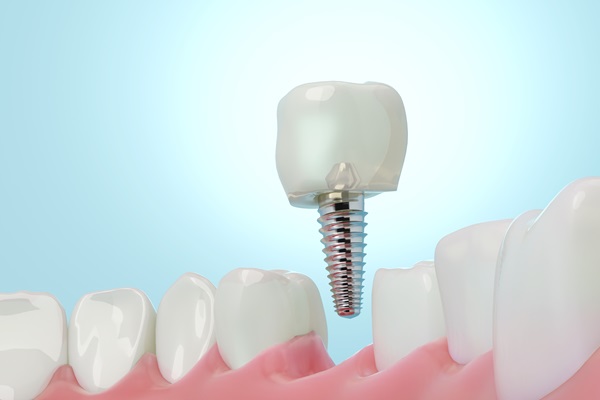 How A Tooth Replacement Can Transform Your Smile